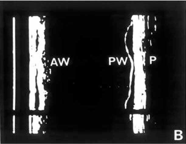 Edler-Echokardiographie