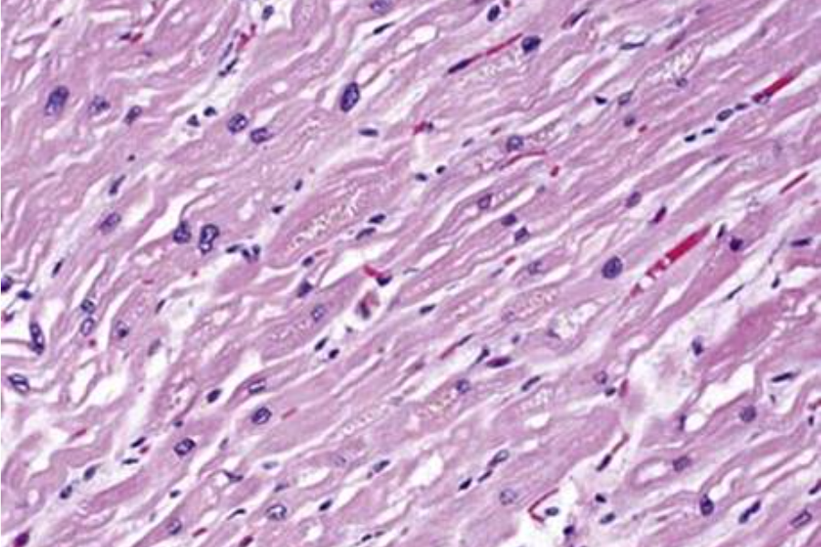 kardiale Hämochromatose