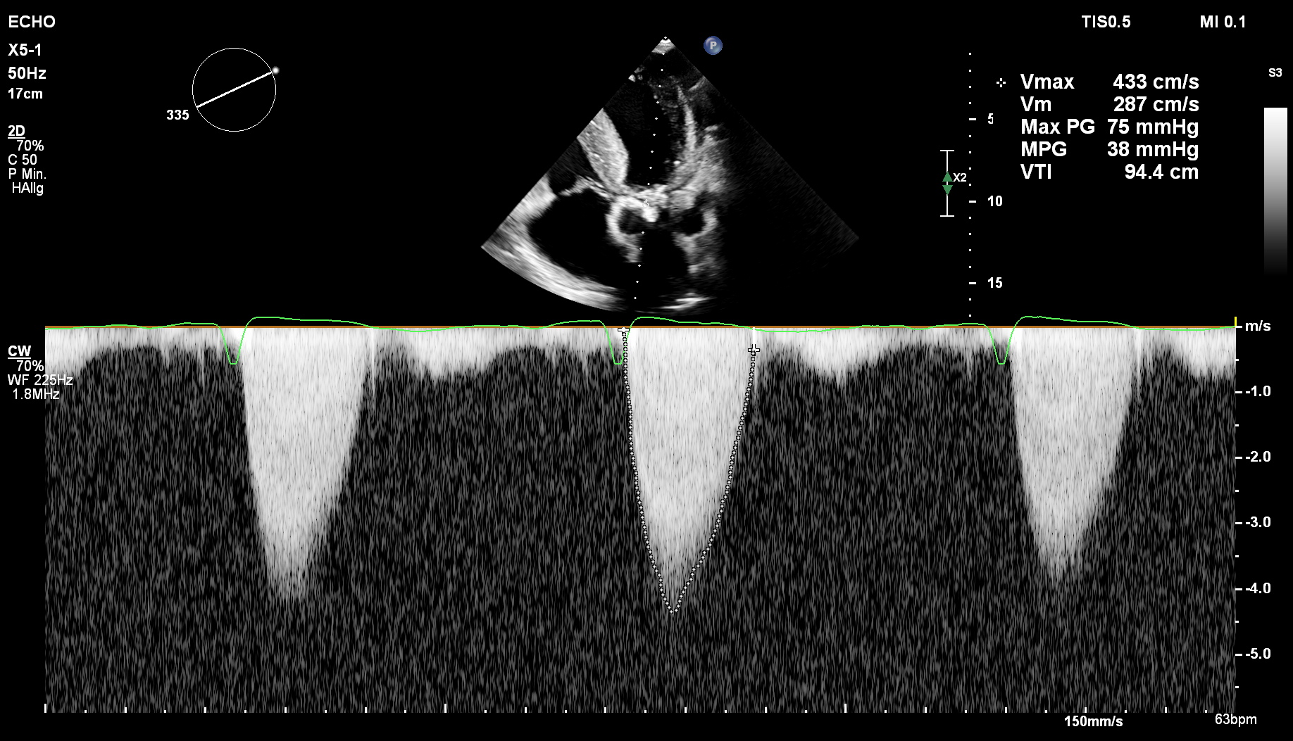 subkostale Schnittebene
