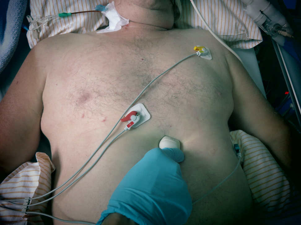 subkostale Schnittebene